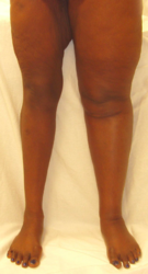 Patient displaying symptoms, swelling of the ankle and foot, of Deep Vein Thrombosis (DVT) in her right leg.